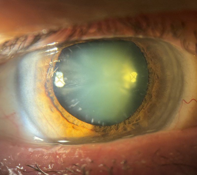 Photographie clinique à la lampe à fente : cataracte mature avec opacification blanchâtre du cristallin visible derrière la pupille dilatée