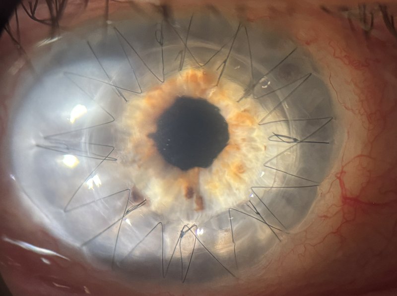 Greffe de cornée — illustration des techniques lamellaires (DMEK, DSAEK, DALK) et de la kératoplastie transfixiante