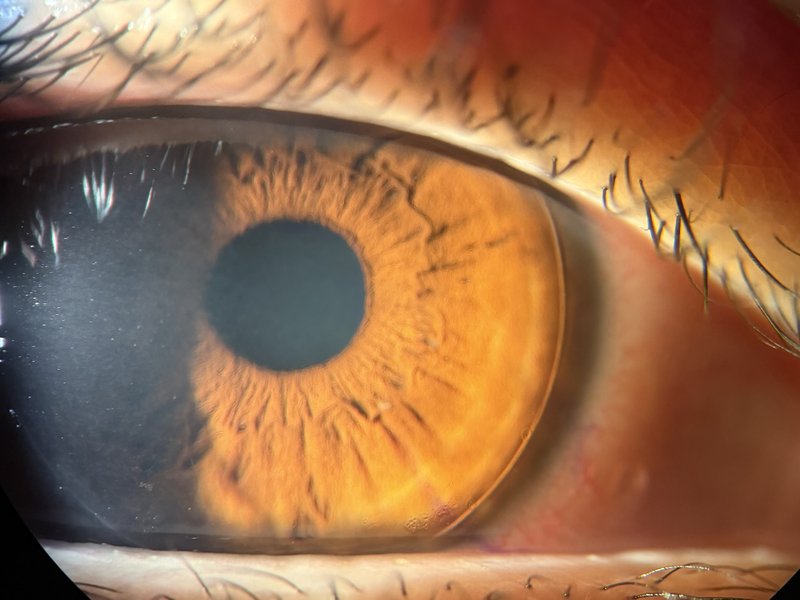 Capot cornéen multifocal créé au laser femtoseconde — étape clé d'une intervention PresbyLASIK pour la correction chirurgicale de la presbytie