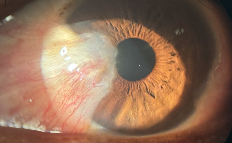 Photographie à la lampe à fente : ptérygion nasal envahissant la cornée — voile fibrovasculaire avec néovaisseaux, canthus interne