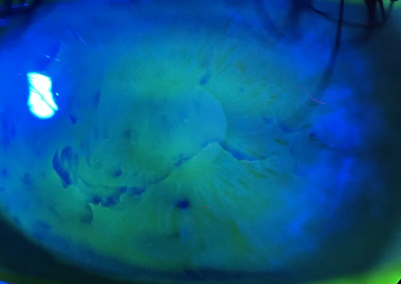 Photographie au biomicroscope d'une cornée colorée à la fluorescéine sous lumière bleu cobalt, montrant des irrégularités de surface épithéliale