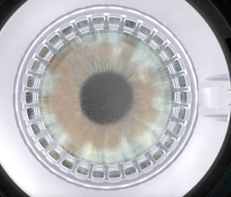 Laser VisuMax (Carl Zeiss) — plateforme utilisée pour la chirurgie SMILE intrastromal au Cabinet OPHTALIFE Boulogne-Billancourt